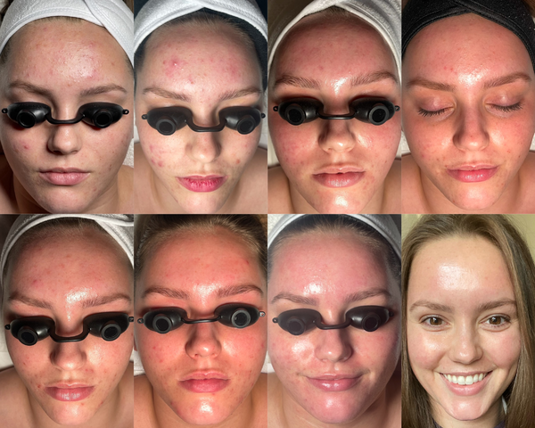 Before and after comparison of a woman's face with laser goggles, showing skin improvement.